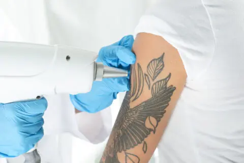 Tattoo Removal