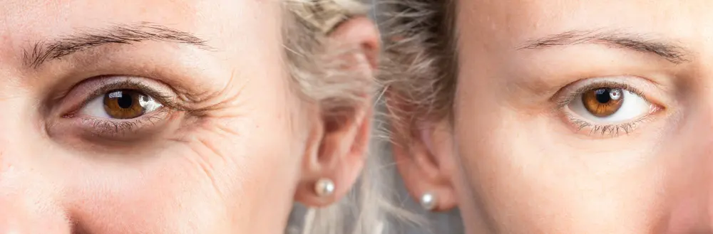 anti ageing before and after