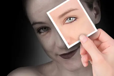 Photo Rejuvenation (IPL)