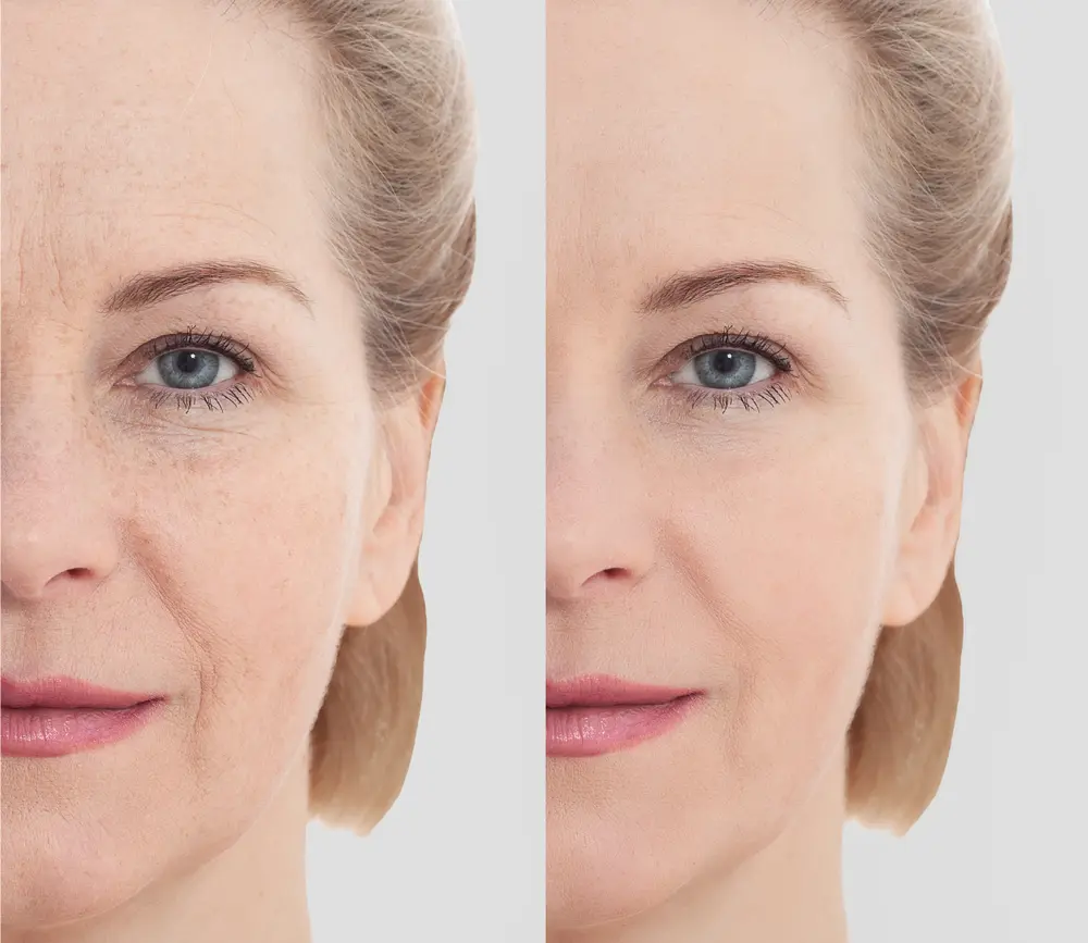 skin rejuvenation before and after
