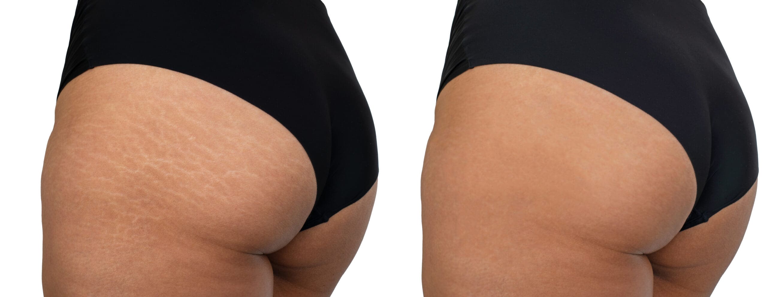 cellulite before and aftet
