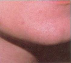 after Laser Hair Removal