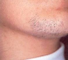 Before Laser Hair Removal