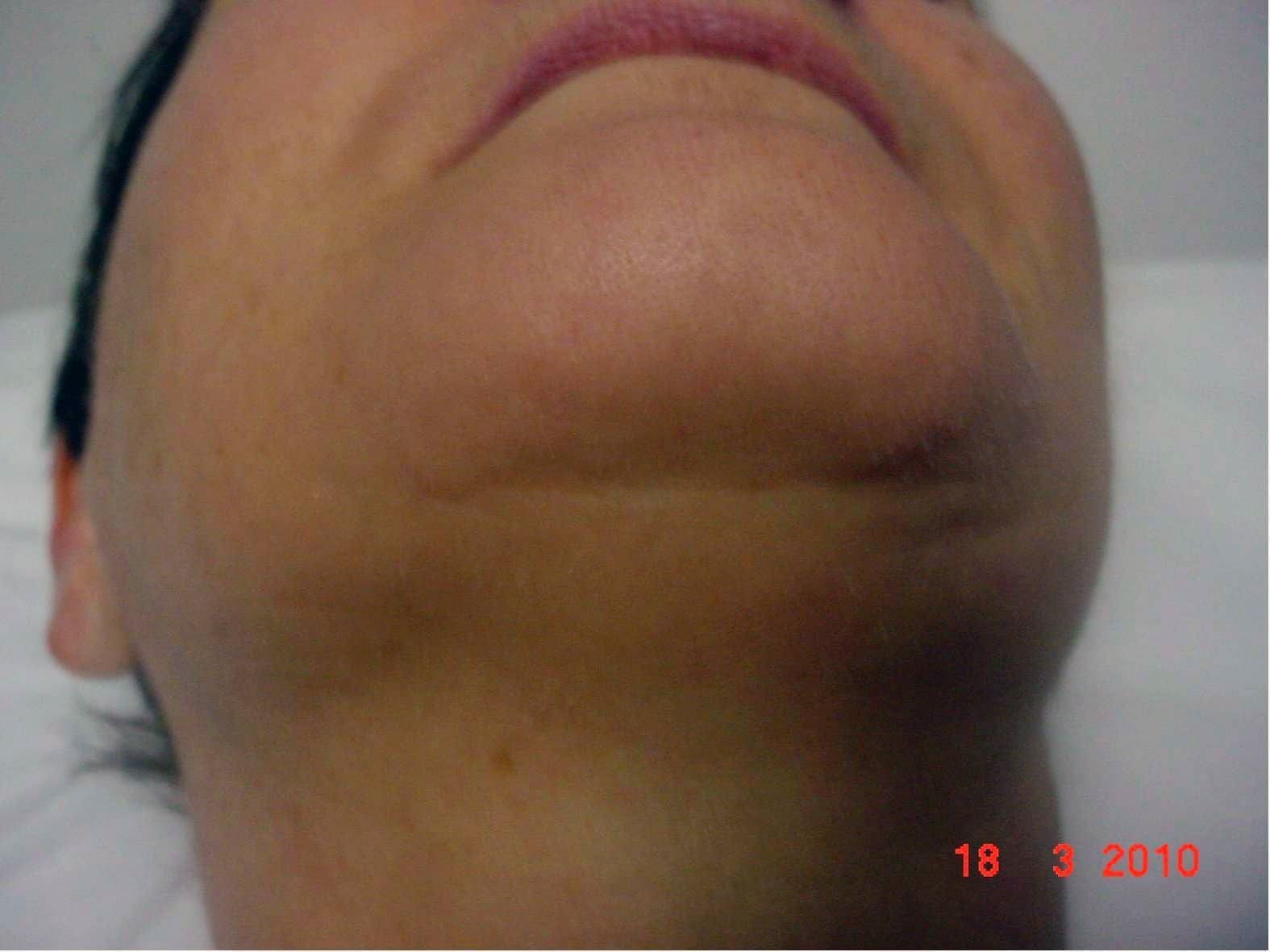 after Laser Hair Removal