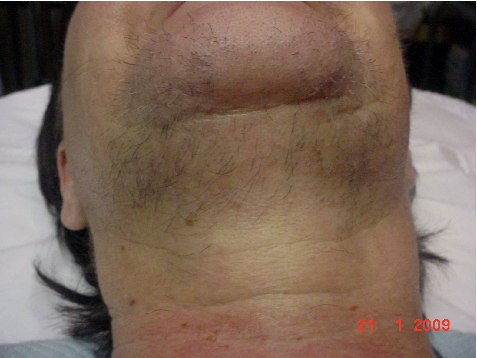 Before Laser Hair Removal