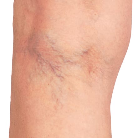 Thread Varicose Veins Before