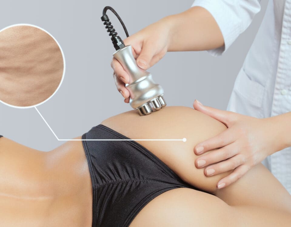 cellulite removal with radio frequency
