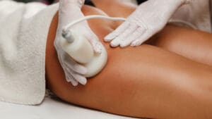 cellulite removal