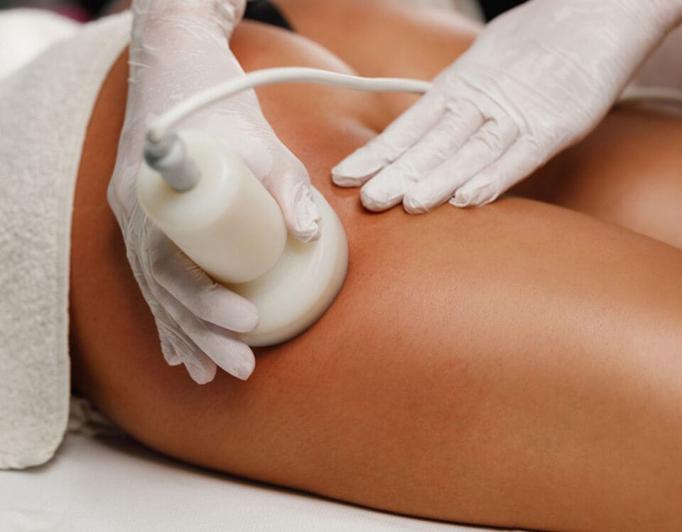 cellulite removal