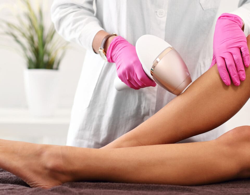 laser hair removal
