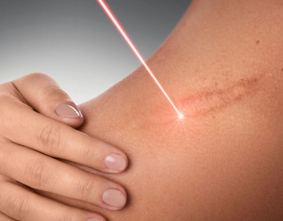 Plasma Laser scar