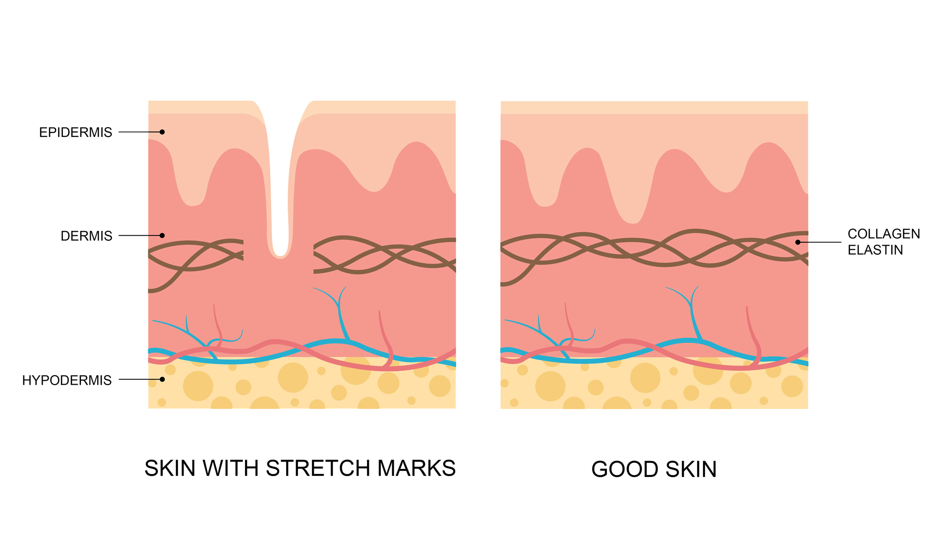 Stretch Marks Before and After