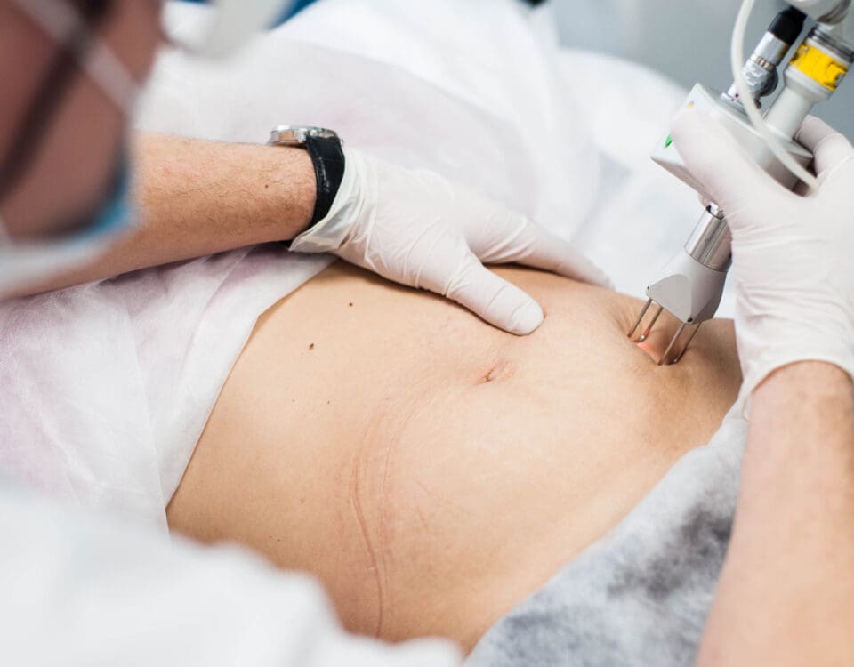 stretch mark removal