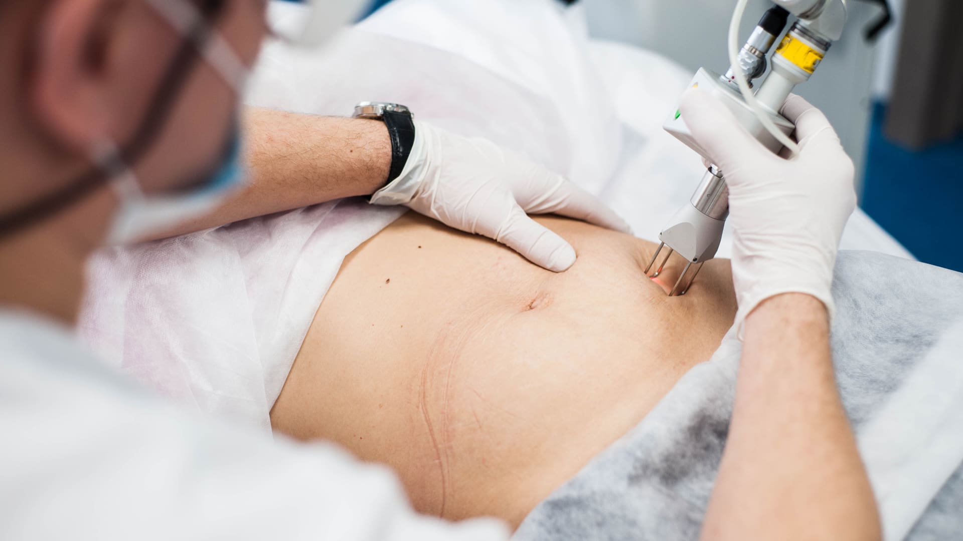 stretch-marks-fractitional-laser stretch mark removal