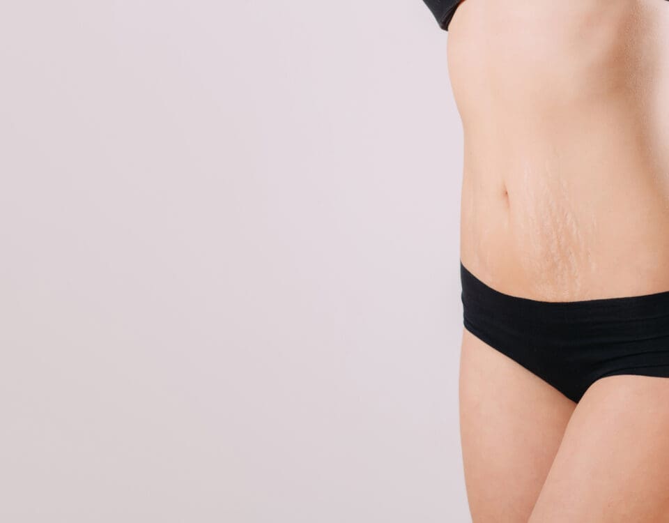 Stretch Marks