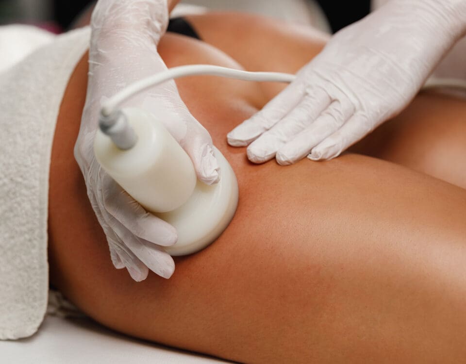 ultrasound cellulite buttocks