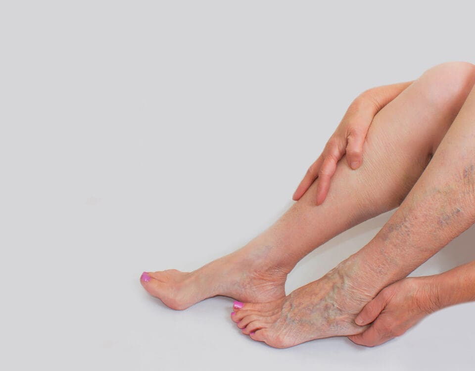 varicose veins header