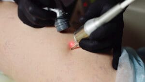 varicose vein removal