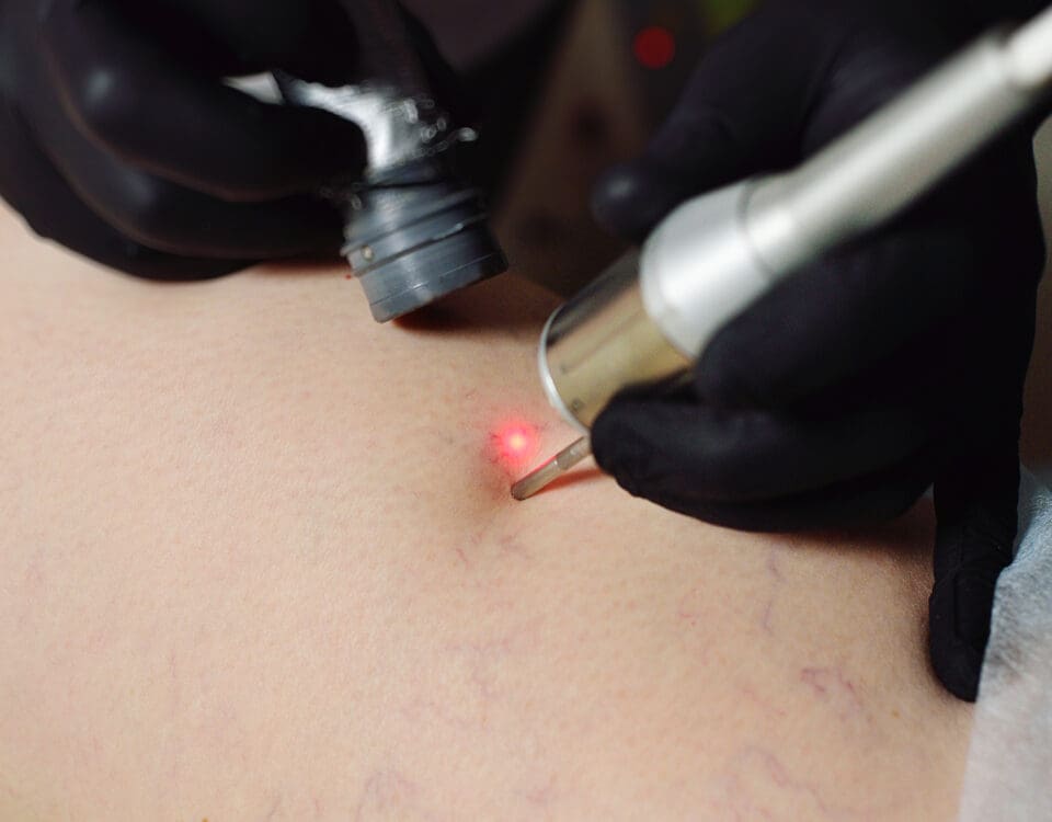 varicose vein removal