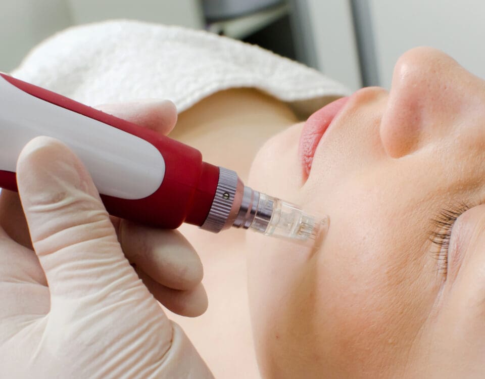 dermapen dermabrasian and skin rejuvenation