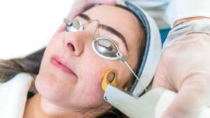 ND YAG LASER Acne Treatment