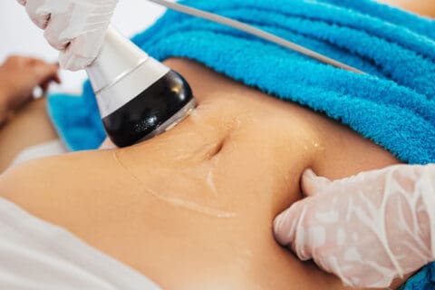 Cellulite Removal