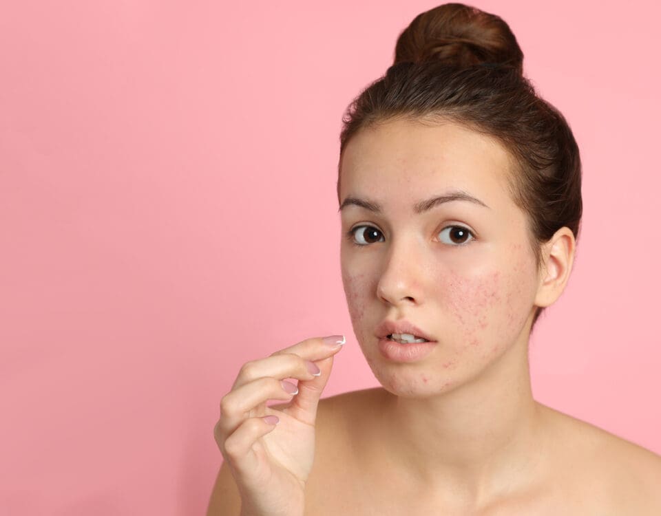 Acne and Acne Scar