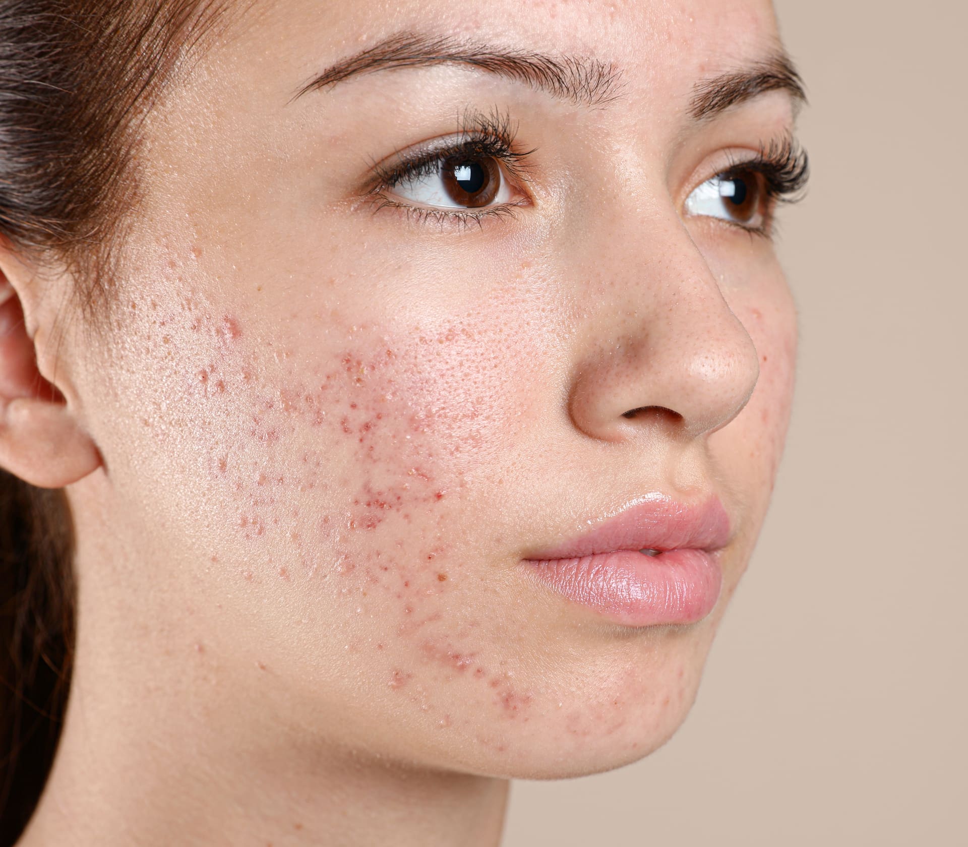 acne before