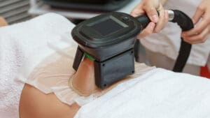 cryolipolysis treatment