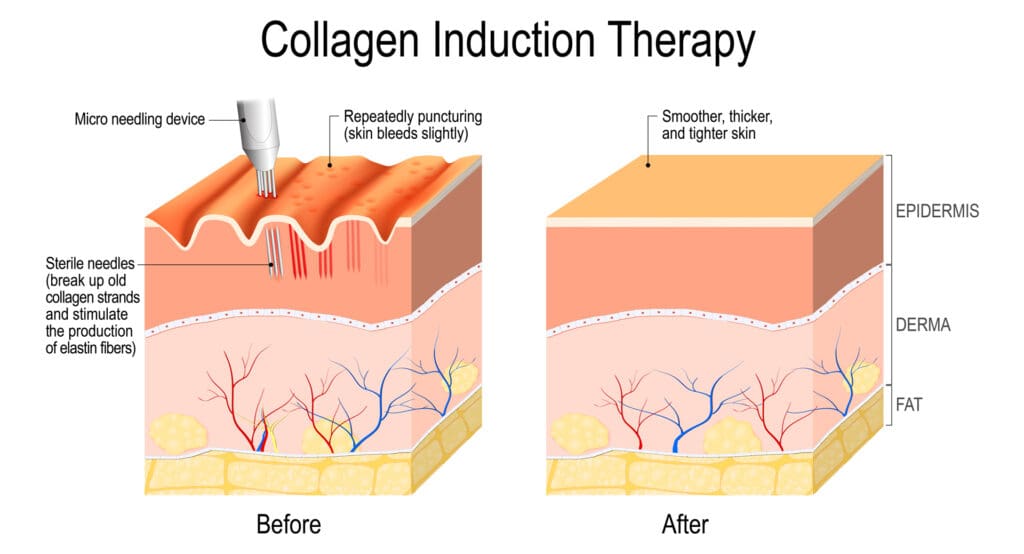 dermapen microneedling detail