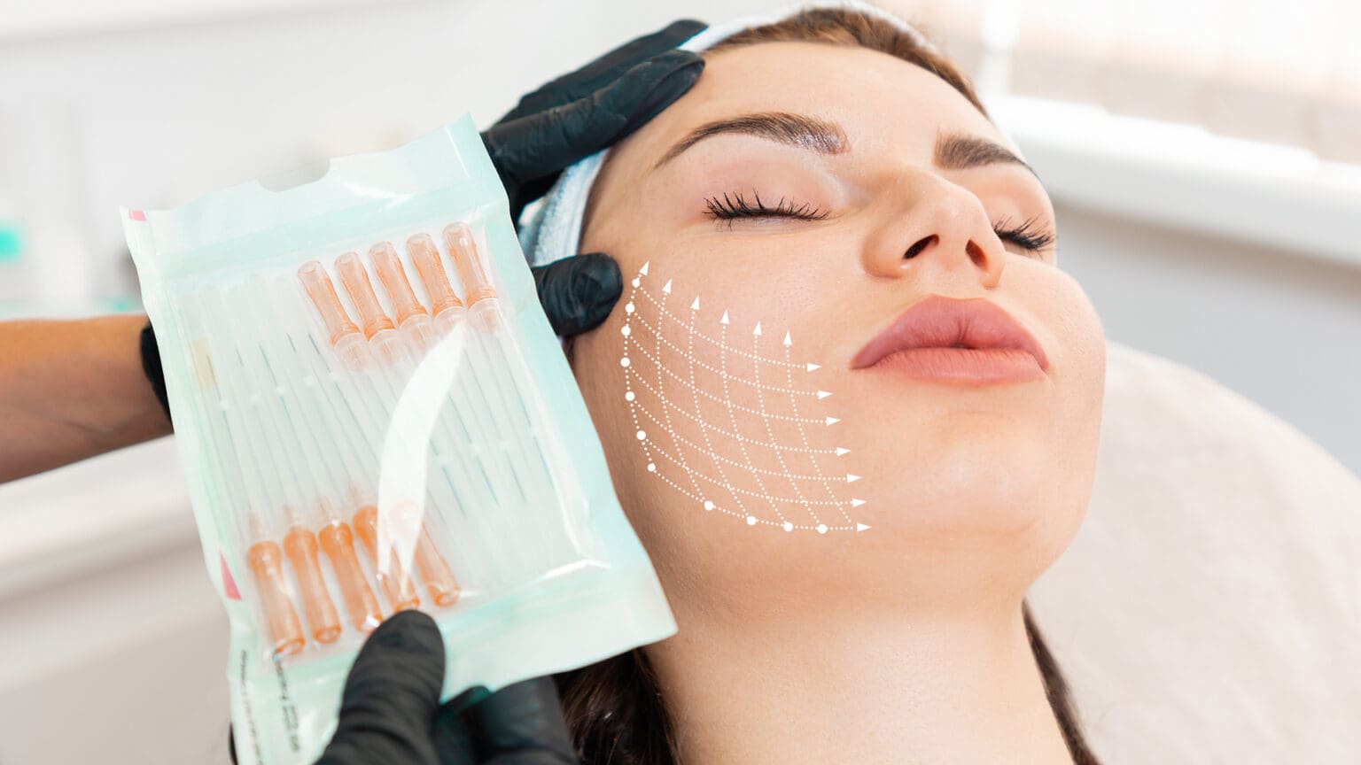 PDL Facial Threading with Silhouette Soft NL Clinic