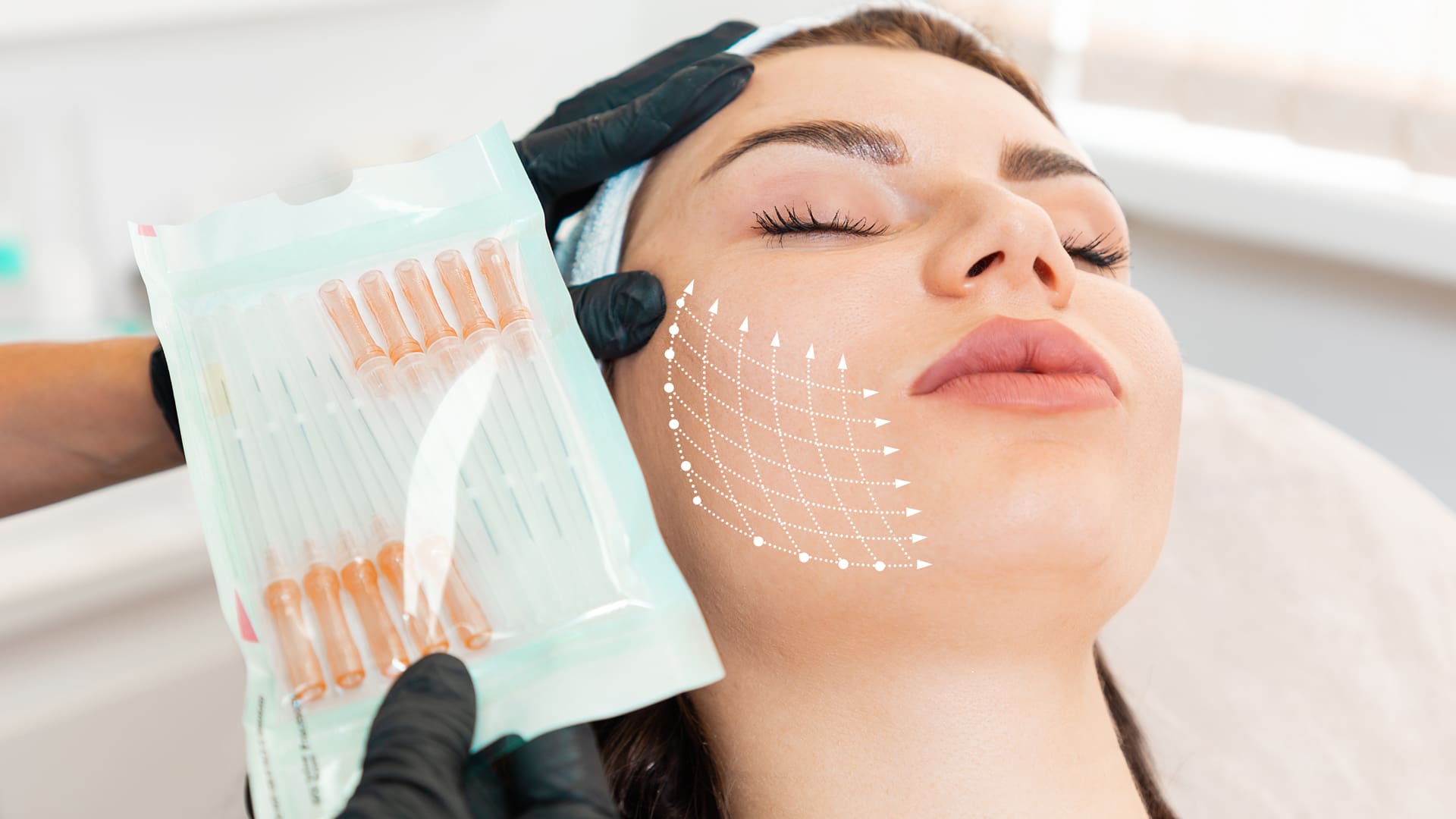 PDL Facial Threading with Silhouette Soft NL Clinic