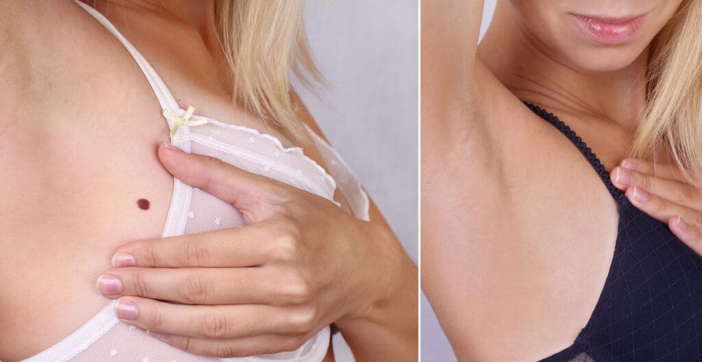 mole removal before and after