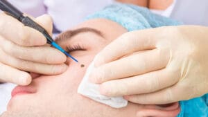 mole removal
