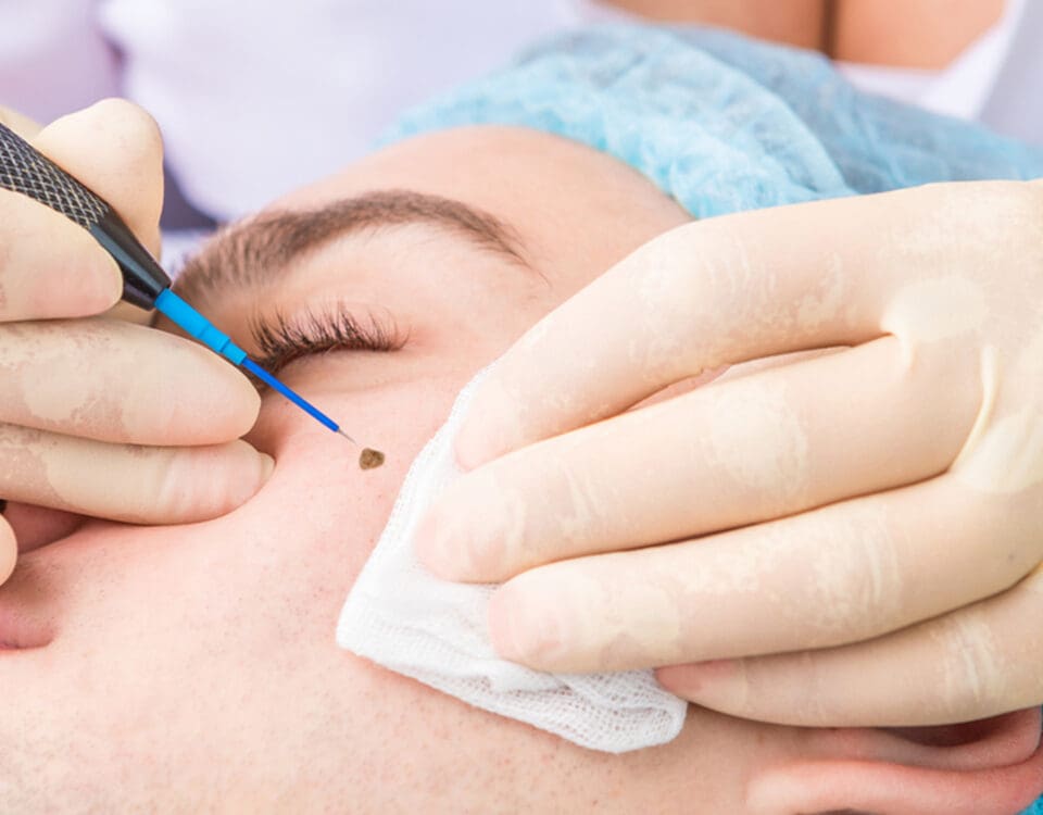 mole removal