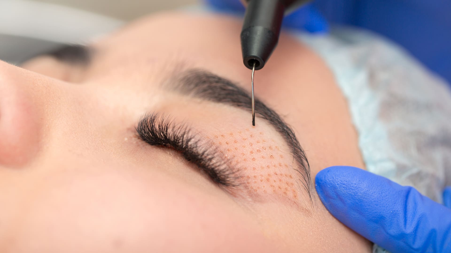 plasma-laser-wrinkle-eye-lift plasma laser eye lift