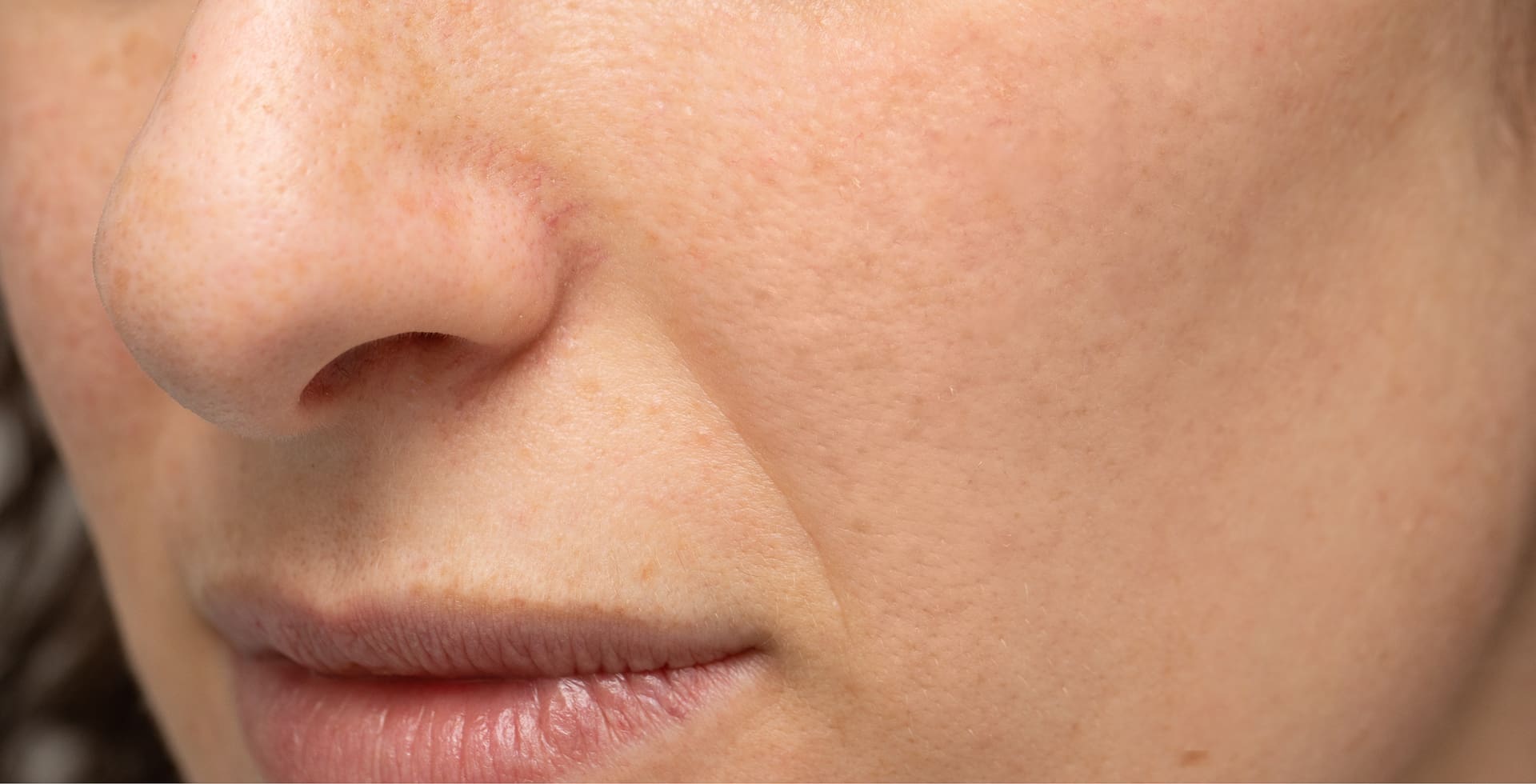 Rosacea after