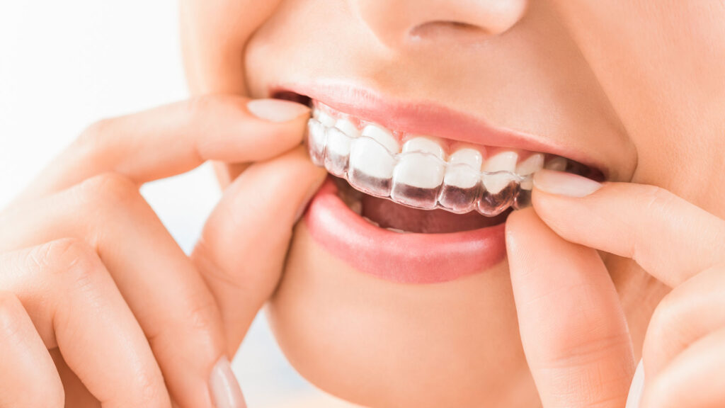 Orthodontics invisible braces