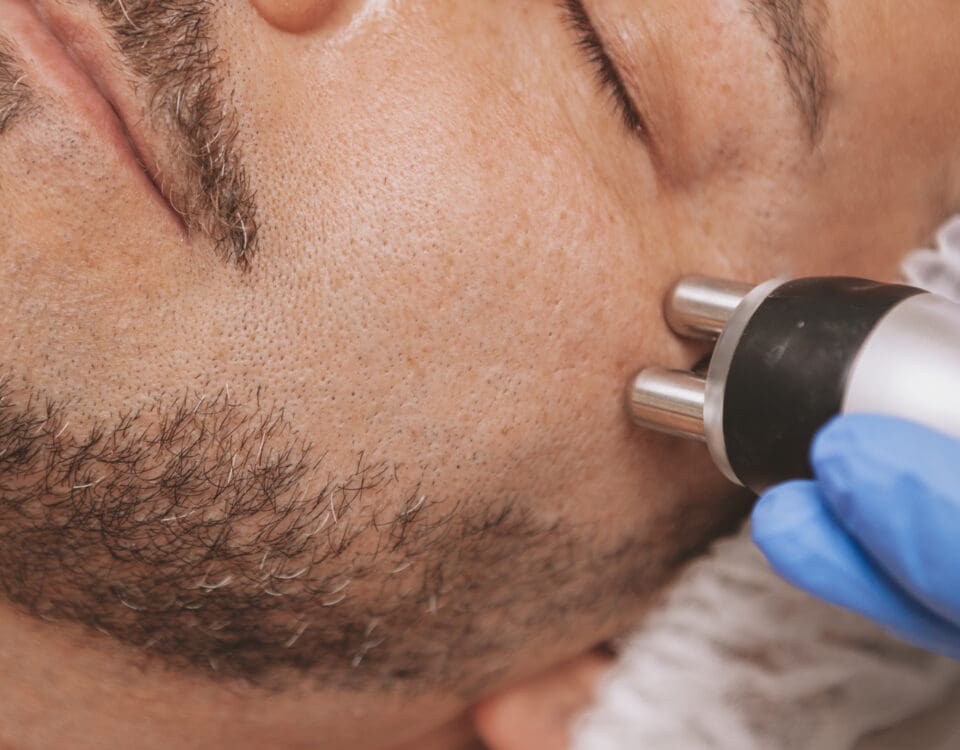 Skin Tightening RF Face