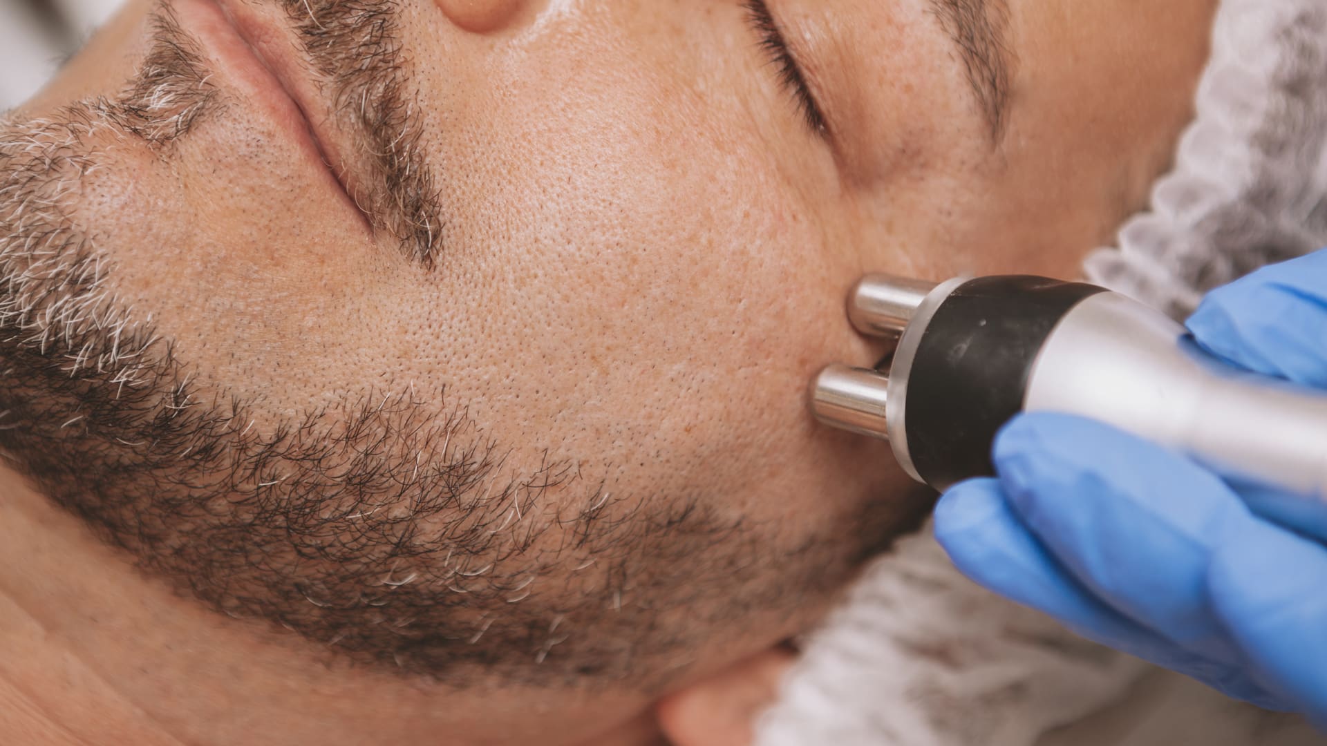 rf-wrinkles-crows-feet Skin Tightening RF Face