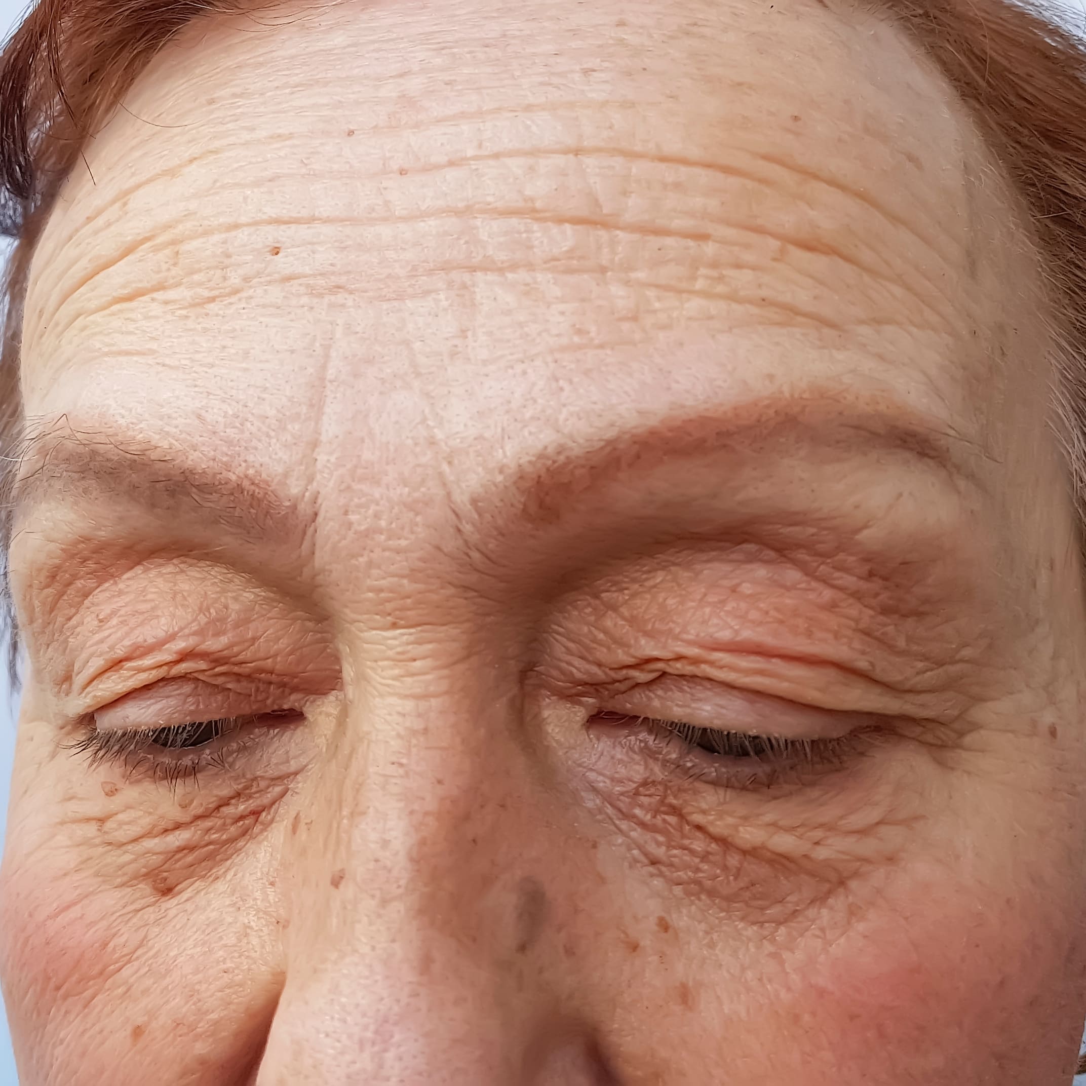 anti-wrinkle-before